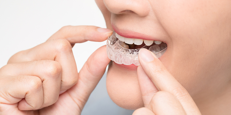 Embrace a New Smile at Family Dental Center: Your Go-To for Invisalign in Union City!